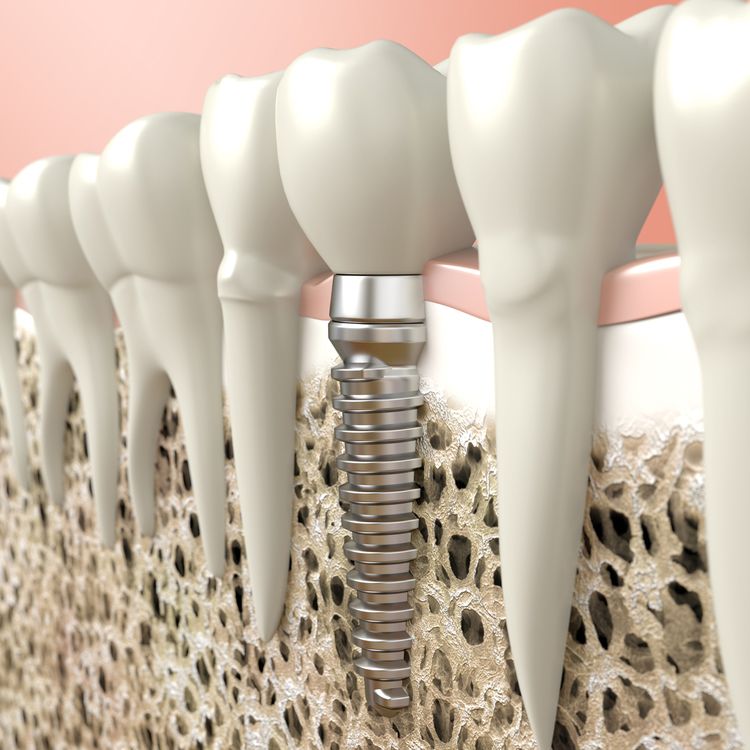 3-D graphic displaying a dental implant placed into jaw after restorative dentistry procedure
