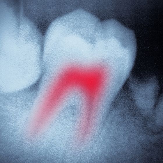 X-ray of showing highlighted root canal in prep for general dentistry procedure