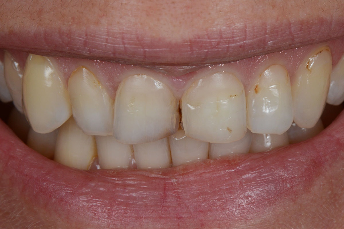 Dental Care - Before