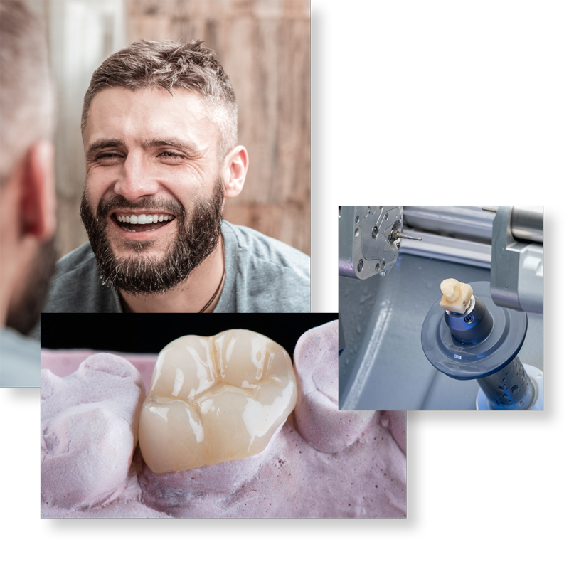 gallery images of middle age man with bearded man, dental implant, and dental crown