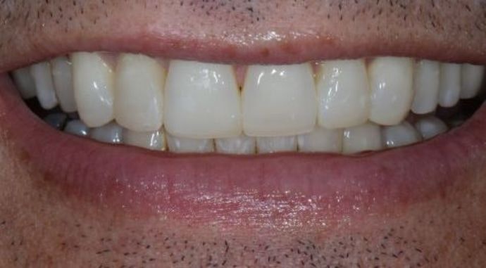 Dr. James Slaman's patient after smile makeover