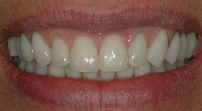 Dr. James Slaman's patient after whitening and veneers