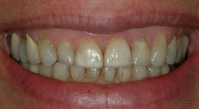 Teeth stained and worn before a smile makeover