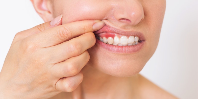 Person pulling back their lip to show inflamed gums