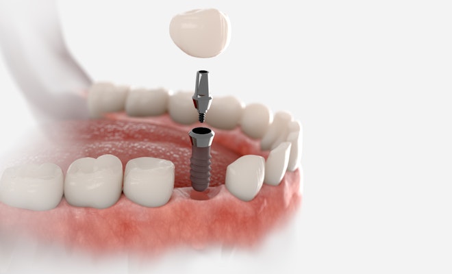 Illustration of an implant-supported crown