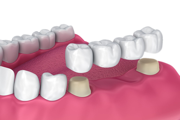 An illustration of a traditional dental bridge