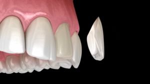 About Ceramic and Composite Veneers