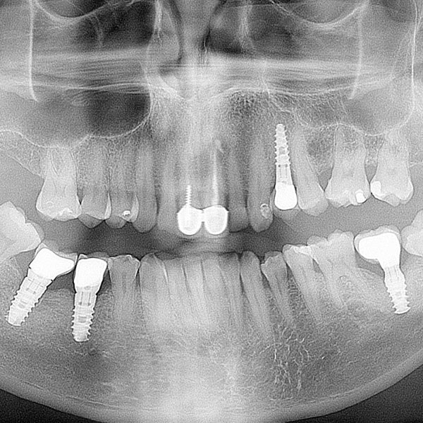 Dental x-ray