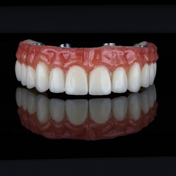 Implant-supported denture