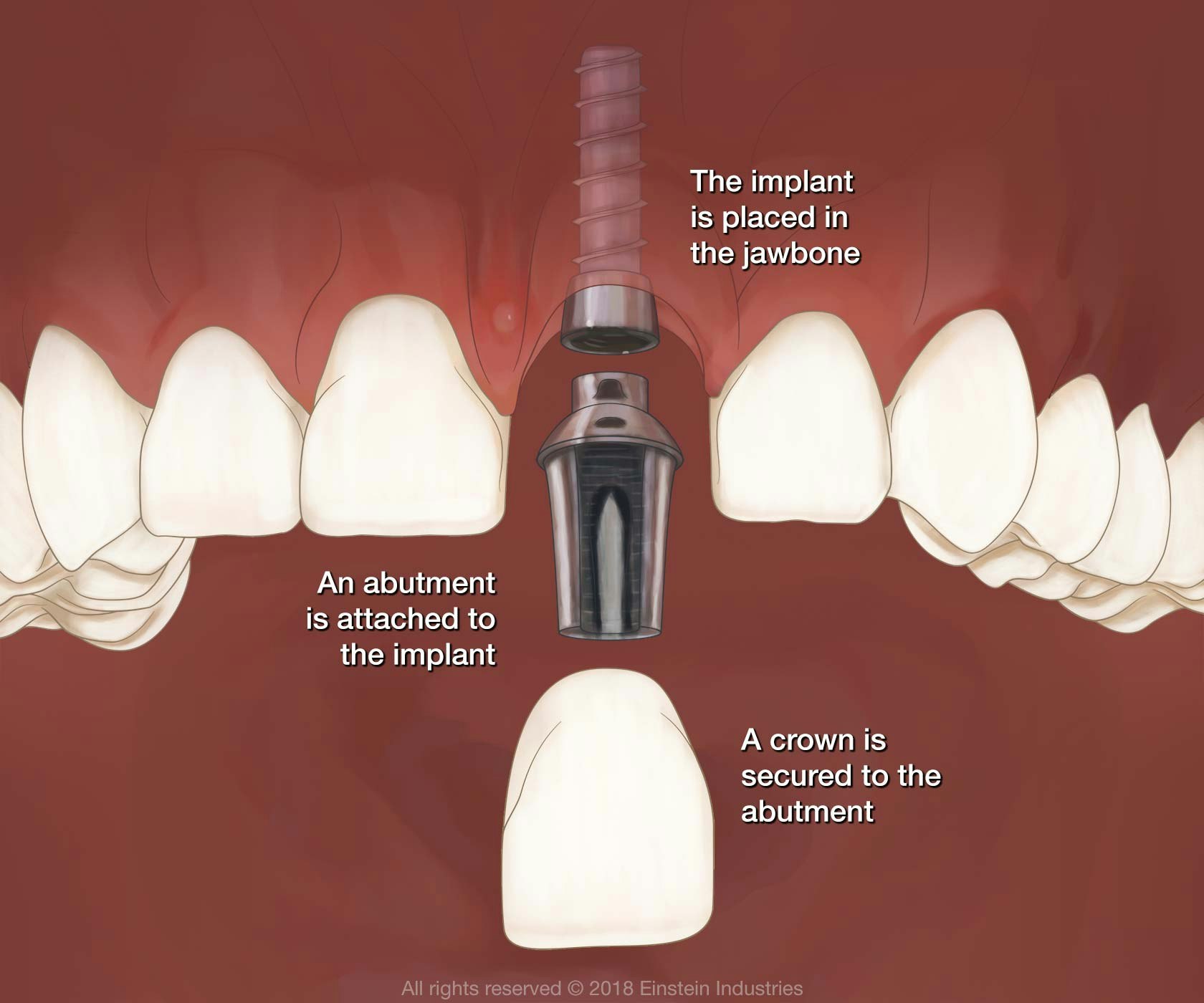 dental implant