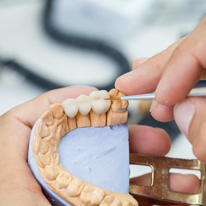 Hand-finishing a dental bridge