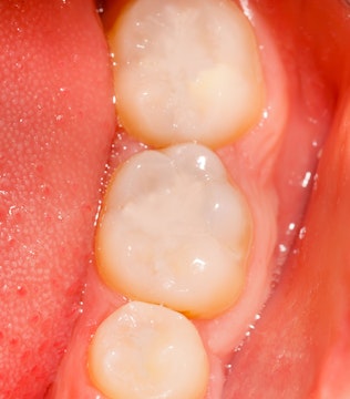 Close-up of dental sealants.