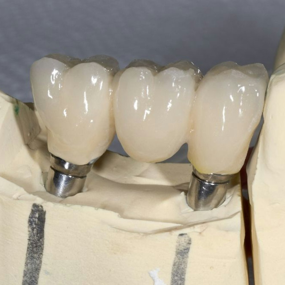 Implant-Supported Dental Bridge