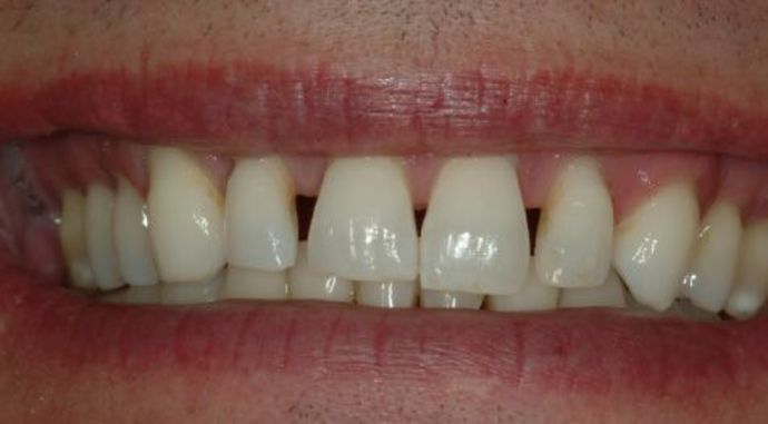 Veneers Case 2 - Before