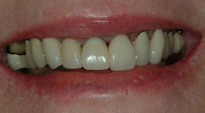 Full Mouth Reconstruction Case 1 - Before