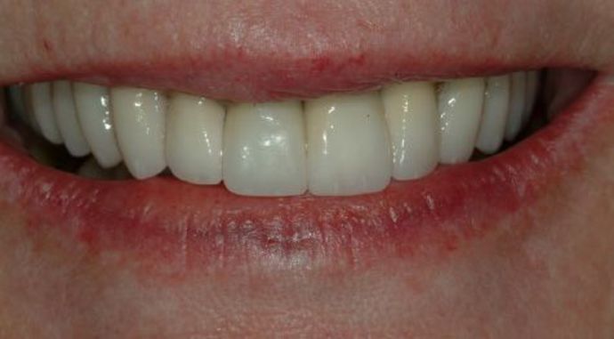 Full Mouth Reconstruction Case 1 - After