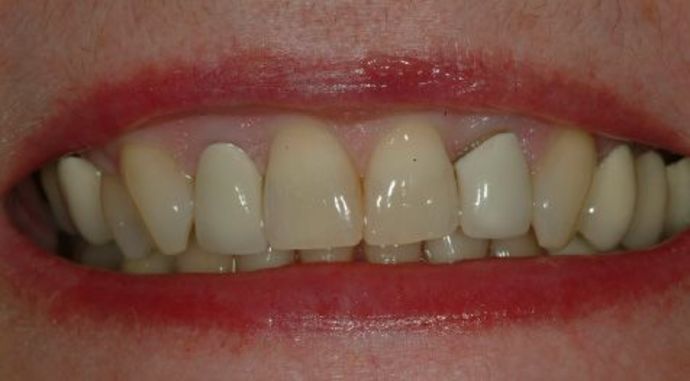 Full Mouth Reconstruction Case 2 - Before