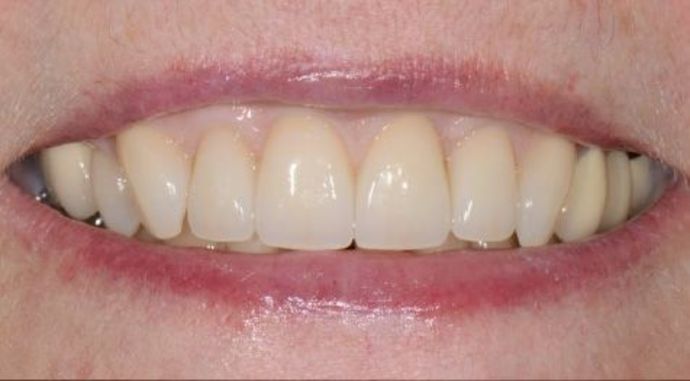 Full Mouth Reconstruction Case 2 - After